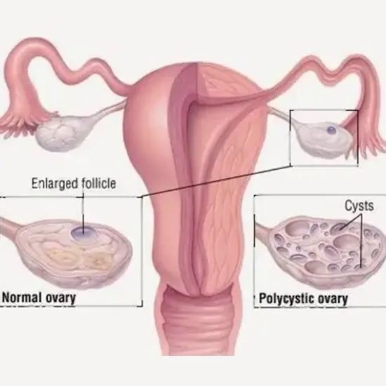GDIC Polycystic Ovarian Disease (PCOD) Package